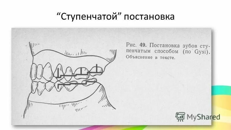 Постановка искусственных зубов. Конструирование зубных рядов п. Конструирование зубных рядов по гизи. Симметрограф коркхауза в ортодонтии. Методика постановки зубов по зиновьеву.