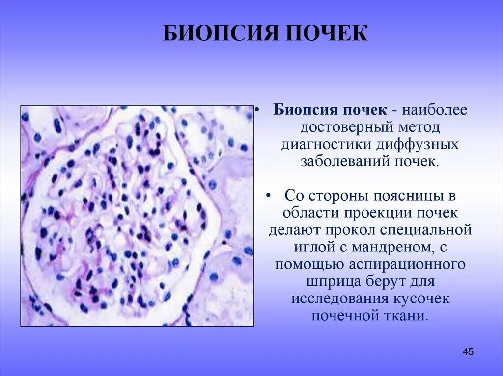 Лечение диффузных почек. Методика пункционной биопсии почек. биопсия почек при хроническом гломерулонефрите. пункционная биопсия почек показания.