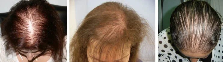 Выпадают волосы 60 лет. Стрижки при алопеции у женщин.