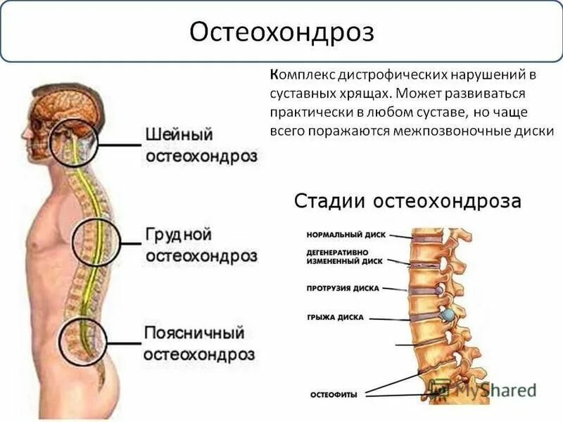 Остеохондроз степени что это значит