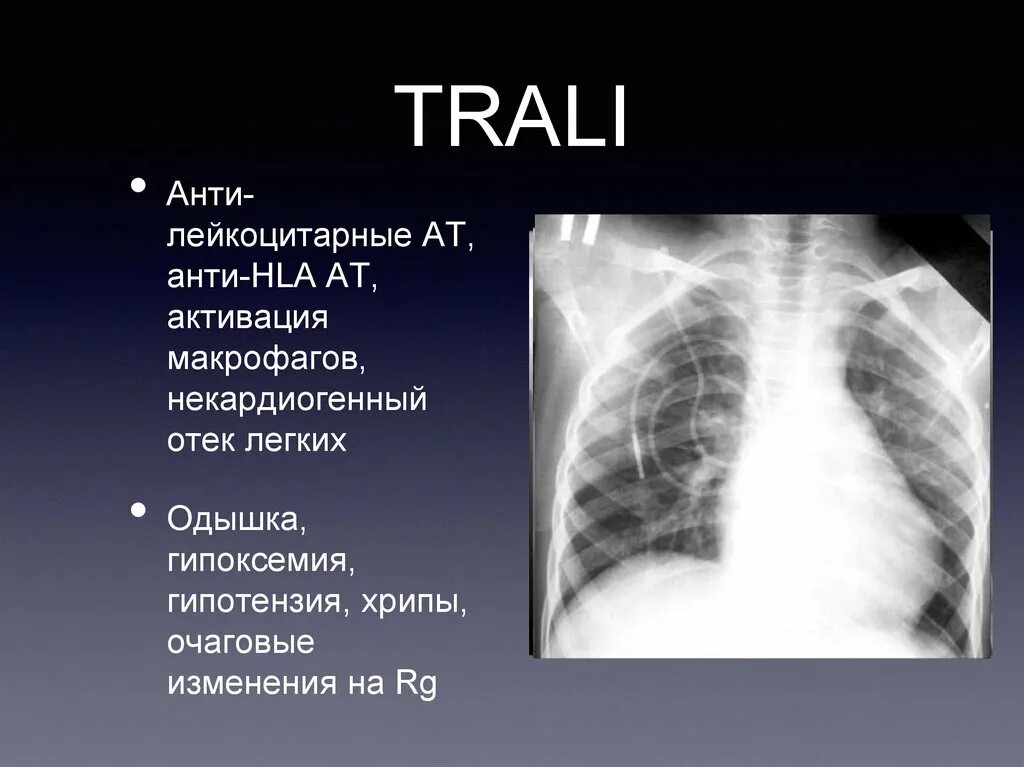 Trali синдром. Кардиогенный и некардиогенный отек легких. Некардиогенный отек легких. Некардиогенный отек легких рентген. Отек легких стадии