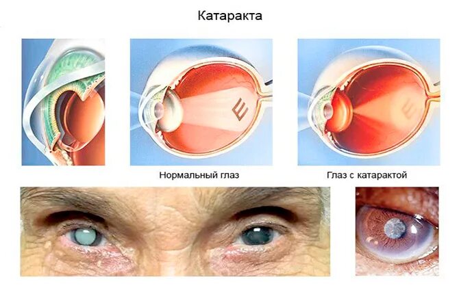 Что нельзя после операции катаракты глаза. Искусственный хрусталик. Катаракта глаза операция. Операция на хрусталик глаза.