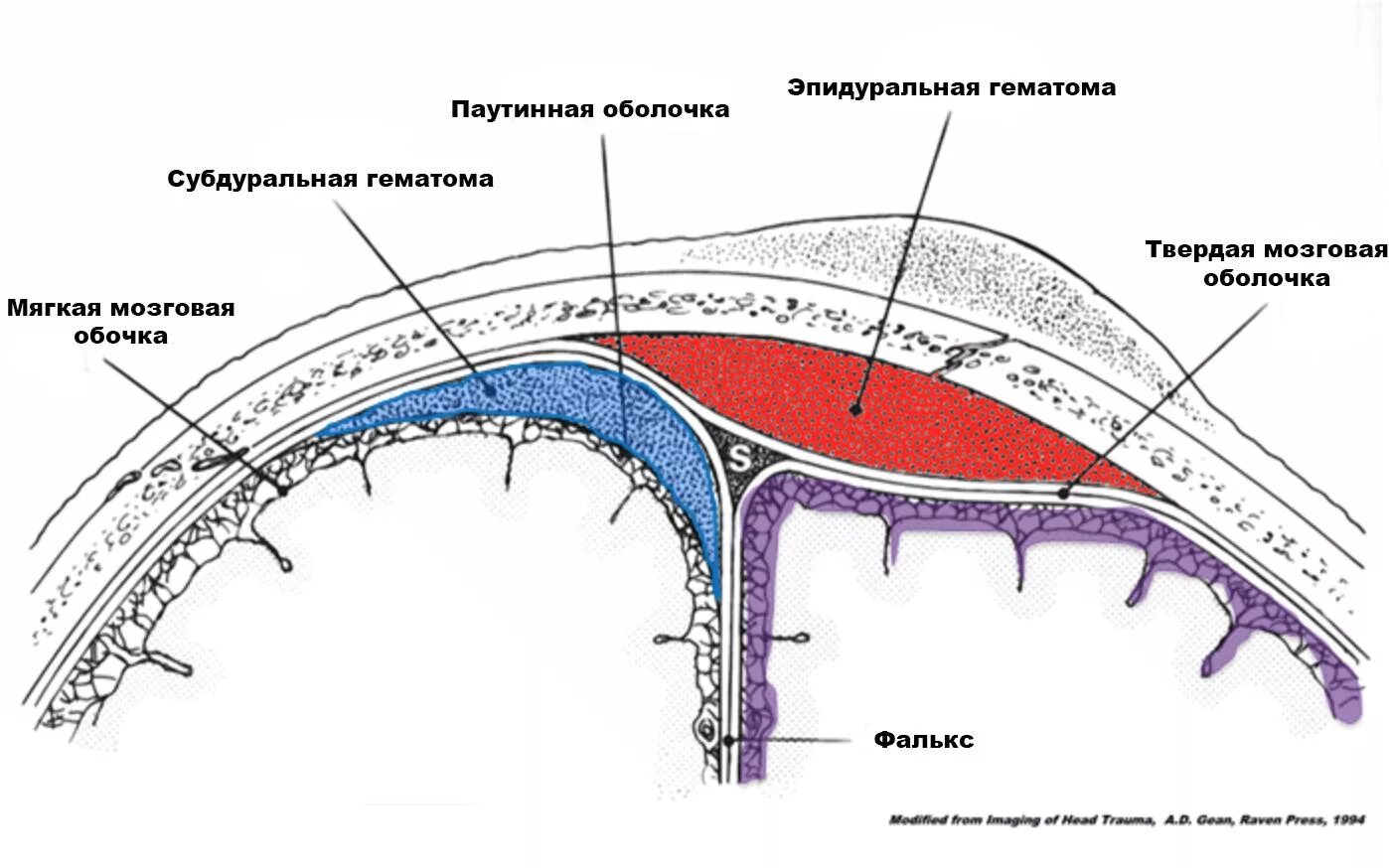 Подобранные оболочки. Субдуральная и субарахноидальная гематома. Субдуральная и эпидуральная гематома. Эпидуральная гематома субдуральная оболочки. Эпидуральное субдуральное субарахноидальное пространство.