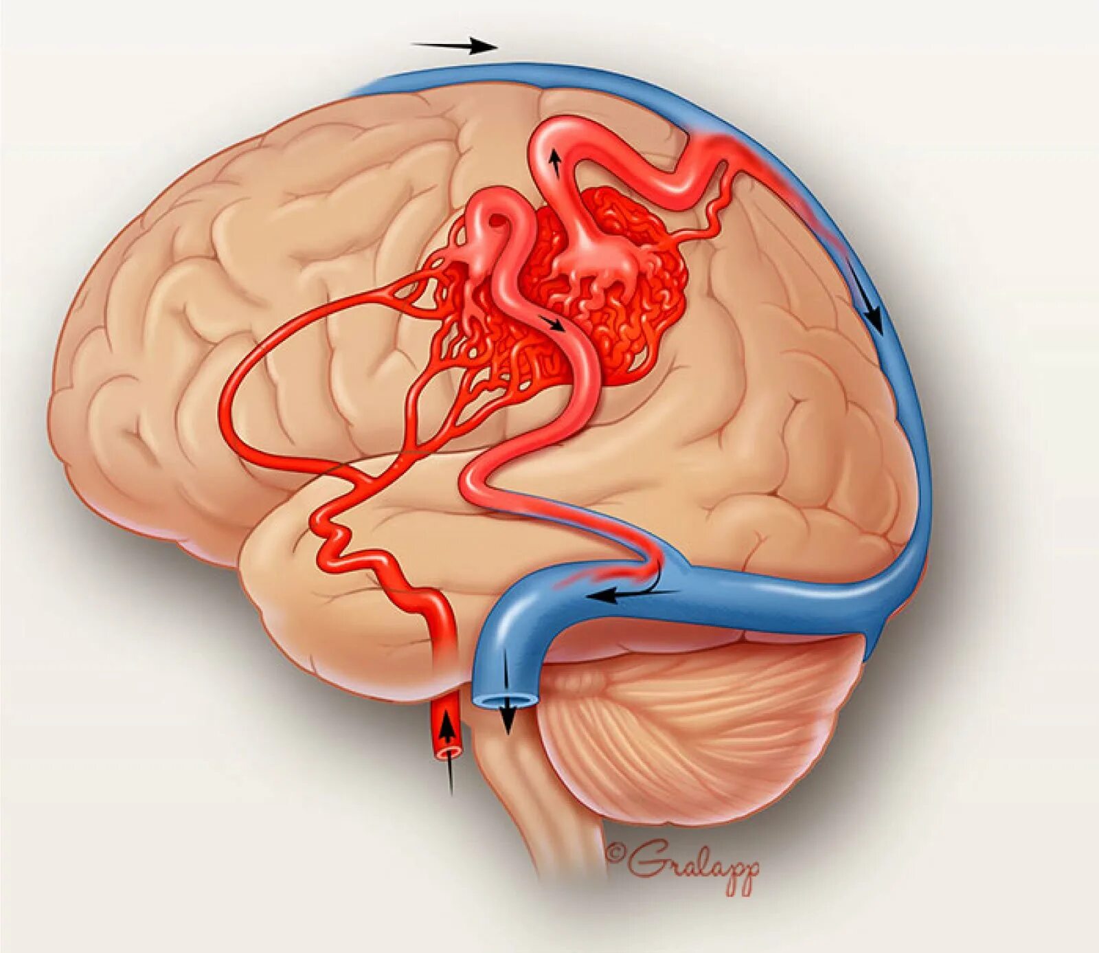 Артериовенозная мальформация ГМ. Артериовенозная мальформация головного мозга. Арерио венозная мальформация. Артериовенозная мальформация вены Галена. Венозная дисциркуляция головного мозга