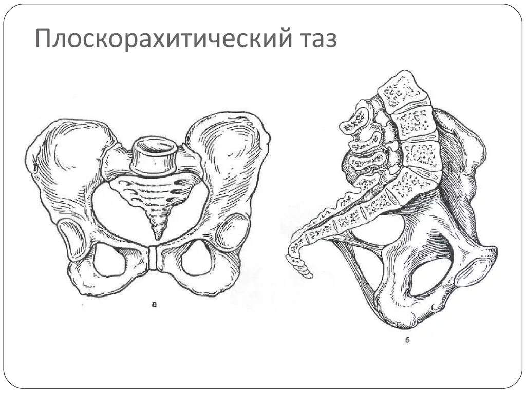 Плоский таз размеры. Плоский таз. Охарактеризуйте простой плоский таз. Плоскорахитический таз. Разновидности плоского таза.