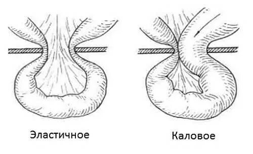 Ущемленная брюшной грыжа. Ущемление грыжи пупочной операция. Эластическое ущемление грыжи. Каловая ущемленная грыжа. Эластическое и каловое ущемление грыжи.