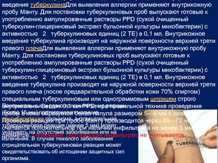 Туберкулин вводят