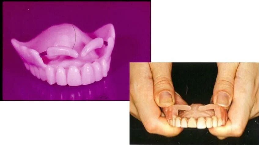 Полный съемный протез фиксация