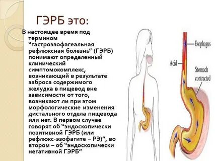 Рефлюкс эзофагит лечение у взрослых препараты диета