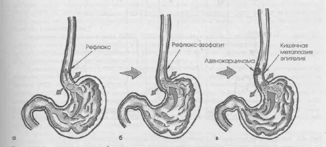 Заброс кислоты из желудка в пищевод симптомы. Рефлюкс-эзофагит неэрозивная форма. Гастральный рефлюкс эзофагит.