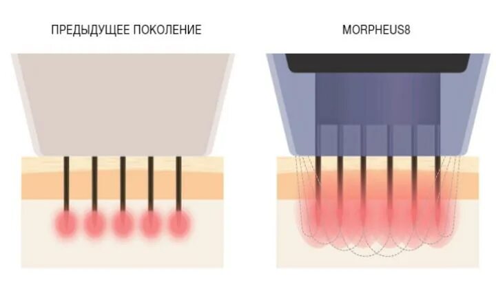 Морфеус 8 процедура. Морфеус 8 процедура