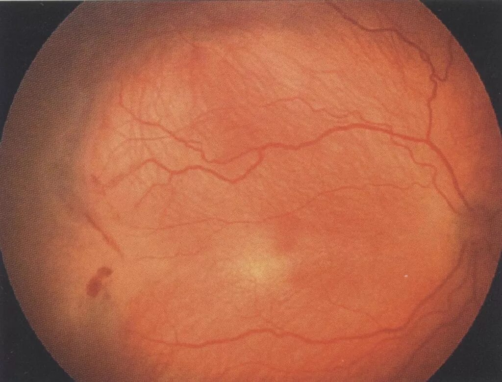 Периферические ретинальные дегенерации. Гипертоническая ретинопатия сетчатки. Ретинопатия при артериальной гипертензии. Ангиоспастическая ретинопатия. Ретинопатия глазное дно.