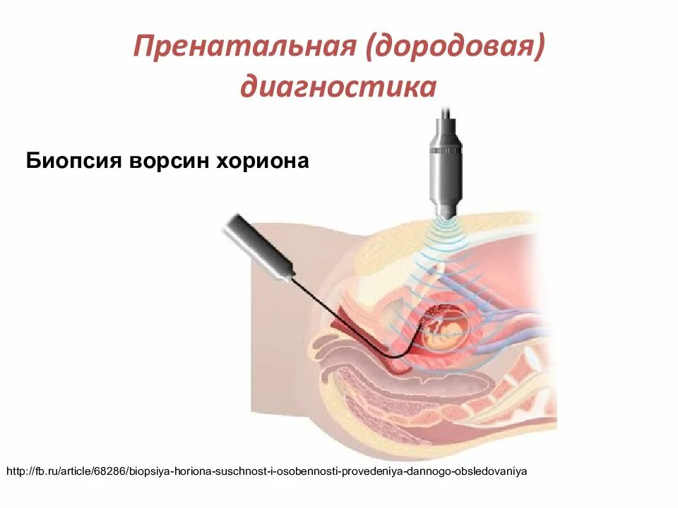 Биопсия выскабливанием. Пренатальная диагностика биопсия хориона. Трансабдоминальная биопсия ворсин хориона. Биопсия плаценты хориона кордоцентез. Биопсия хориона показания сроки.