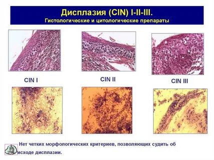Дисплазия карцинома