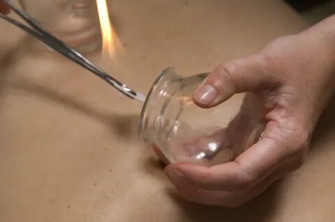 Cupping is Also a European Tradition. Learn How! - Acupuncture Points