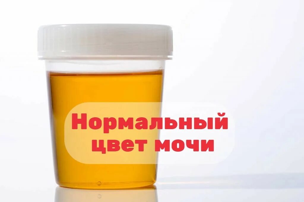 Моча темная при каких болезнях. Темная моча. моча темного цвета.
