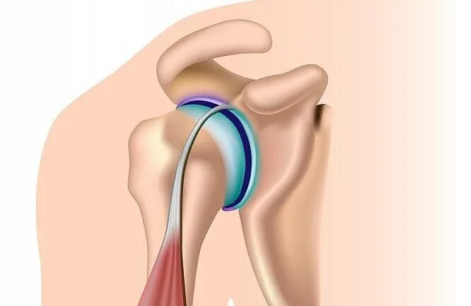 Тендинит сухожилия бицепса плечевого. Мениск плечевого сустава. Тендинит сухожилия бицепса плечевого сустава. Эффективное лечение плечевого сустава
