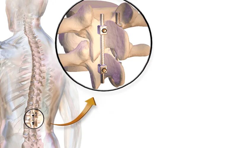 Операция на позвоночник с металлоконструкцией. Исправление позвоночника кручением. Операция на позвоночник с металлоконструкцией инвалидность