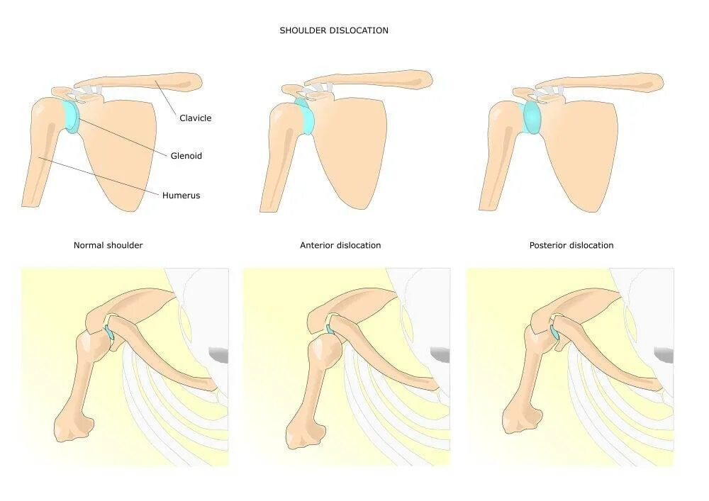 Вывих плечевого сустава формулировка диагноза. Постоянный вывих. Плечелопаточный сустав,вывих. Подклювовидный вывих плеча кт. Передний подклювовидный вывих плеча.