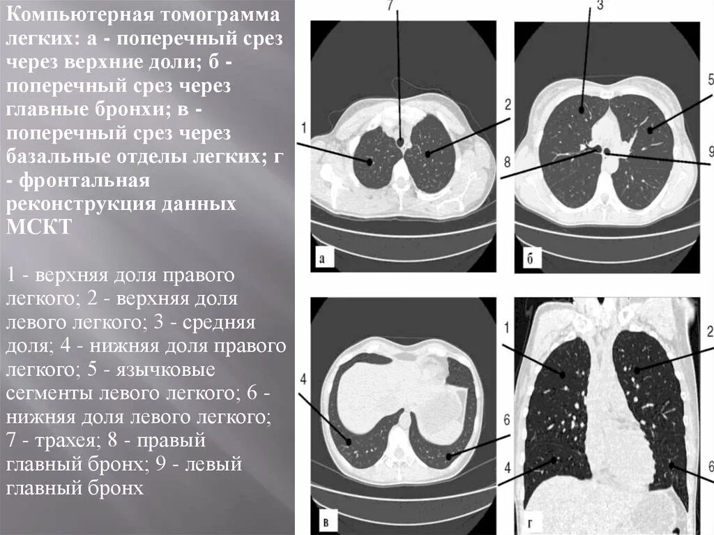 Базальные отделы легких на кт. Срезы легких на кт. Компьютерной томограммы легких срезы отделы. СКТ лёгких. Легкие кт 1