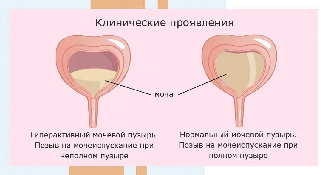 Неполное мочеиспускание. Нейрогенный мочевой пузырь. Патология мочевого пузыря. Переполнение мочевого пузыря. Растянутый мочевой пузырь.