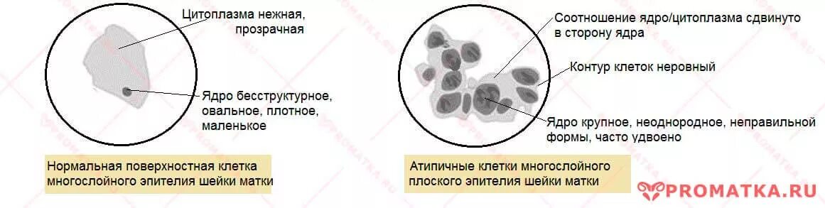 Атипичные клетки плоского эпителия. Атипичные клетки плоского эпителия в цитологии шейки матки.