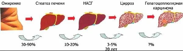 Стадии ожирения печени. Жировой стеатоз печени. Гепатоз ожирение печени.
