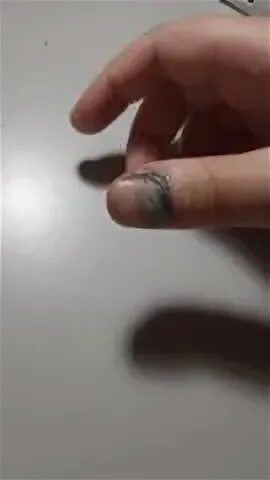 Ушибла палец на руке чем мазать