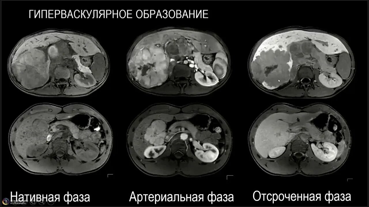 Гиповаскулярное образование в печени. Гиперваскулярные образования печени на кт. Гиперваскулярные образования печени на мрт. Гиповаскулярные образование в печени мрт. Гиповаскулярные метастазы печени мрт.