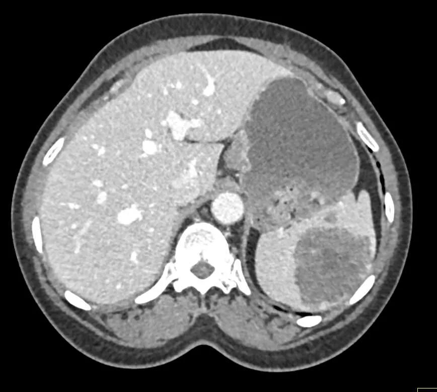 Гиперваскулярный очаг в селезенки кт. Билиарные гамартомы печени на кт. Лимфома Ходжкина кт селезенка. Распад селезенки
