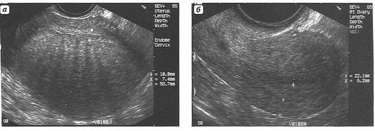 Признаки внутреннего эндометриоза на узи. Эндометриоз матки снимки УЗИ. Внутренний эндометриоз на УЗИ. Наружный и внутренний эндометриоз.