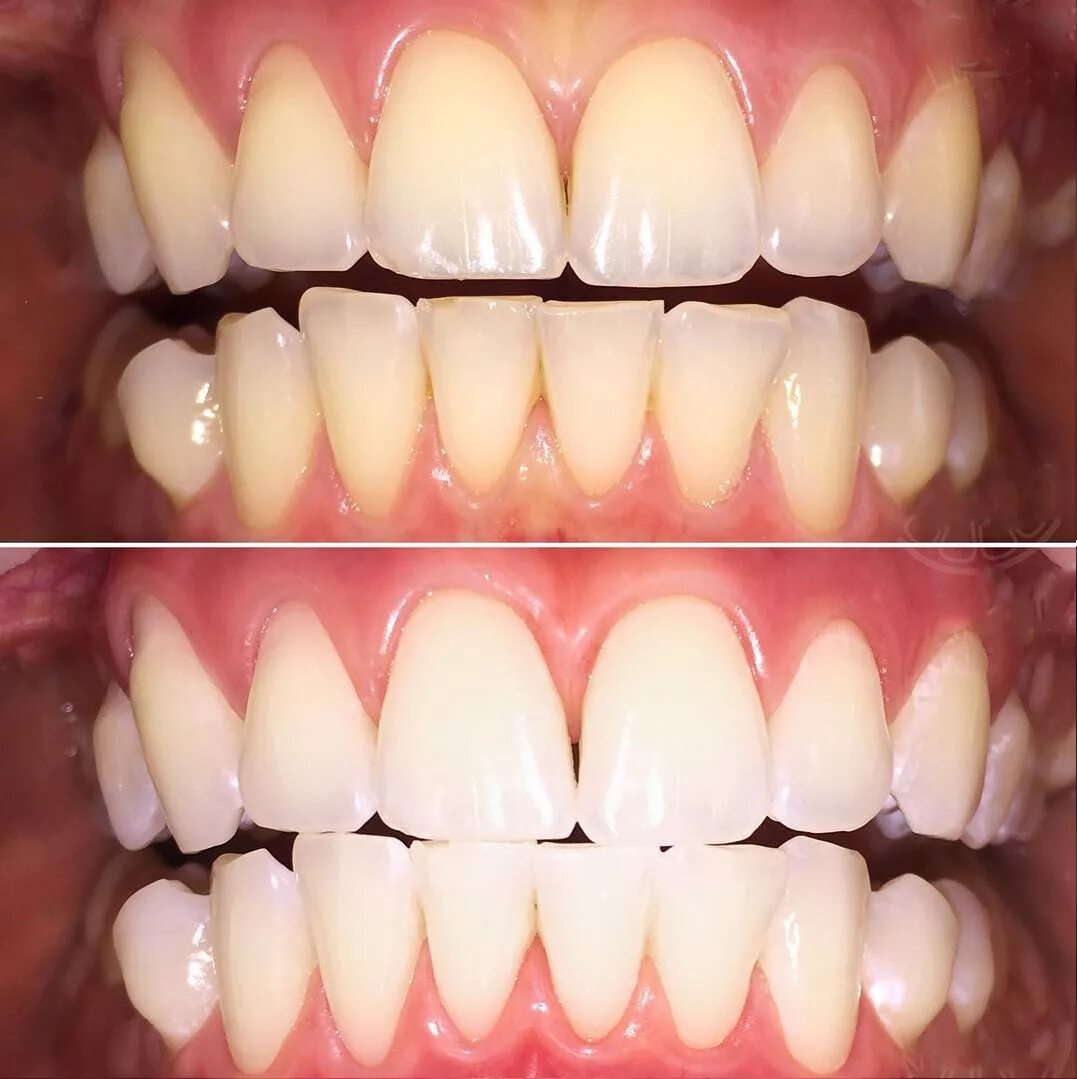 Отбеливание полости рта. Отбеливание зубов. Лазерное отбеливание зубов. Отбеливание зубов до и пос. Зубы до и после отбеливания.