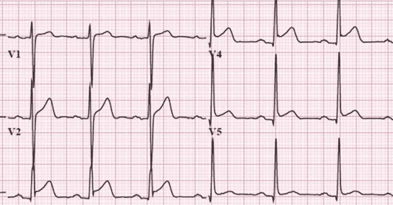 Qrs m 30