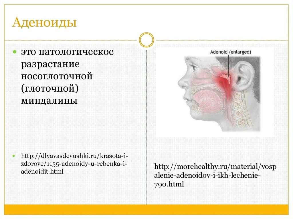 Аденоиды признаки. Разрастание глоточной миндалины. Классификация аденоидов.