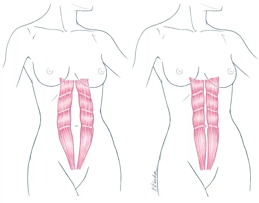 Прямая мышца живота у женщин. Диастаз абдоминальных мышц. Диастаз брюшной стенки. Диастаз мышц брюшного пресса.