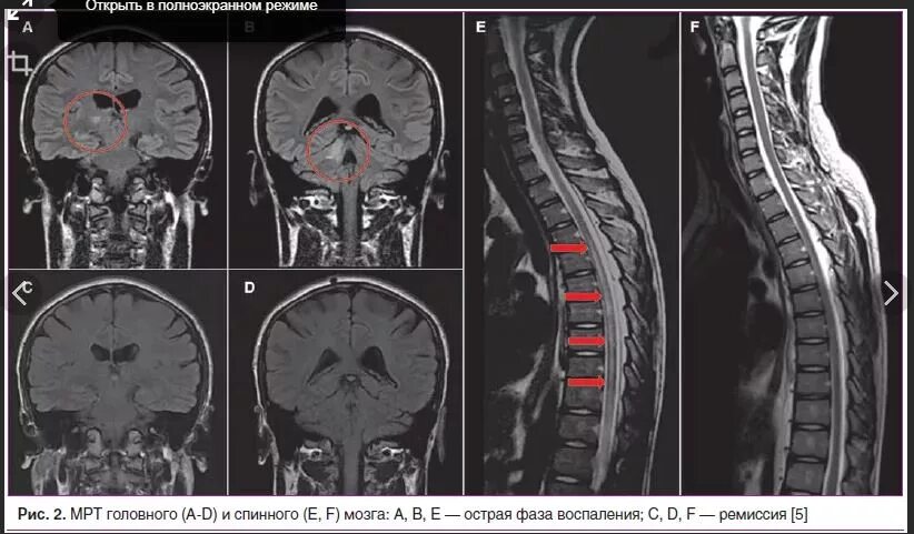 Можно ли мрт с ретейнерами. Оптикомиелит девика. Нейромиелит девика. Демиелинизация спинного мозга мрт. Боковой амиотрофический склероз мрт спинного мозга.