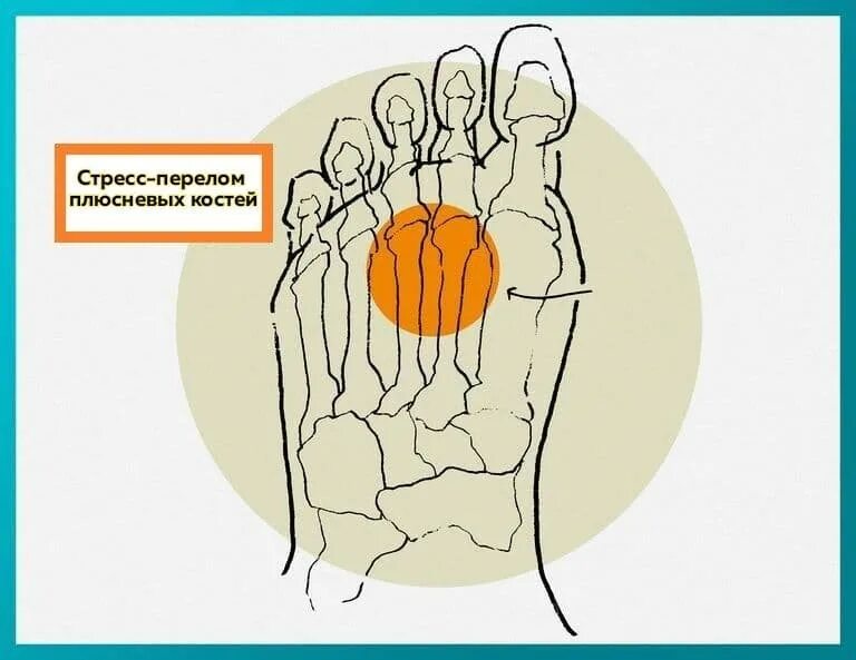 Середина стопы. Боль по тыльной стороне переднего отдела стопы. Болит передний отдел стопы. Средний отдел стопы сильные боли.