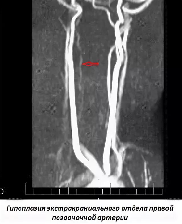 Гипоплазия v4 позвоночной артерии. Гипоплазия позвоночной артерии кт. Гипоплазия позвоночной артерии мрт. Аплазия позвоночной артерии мрт.