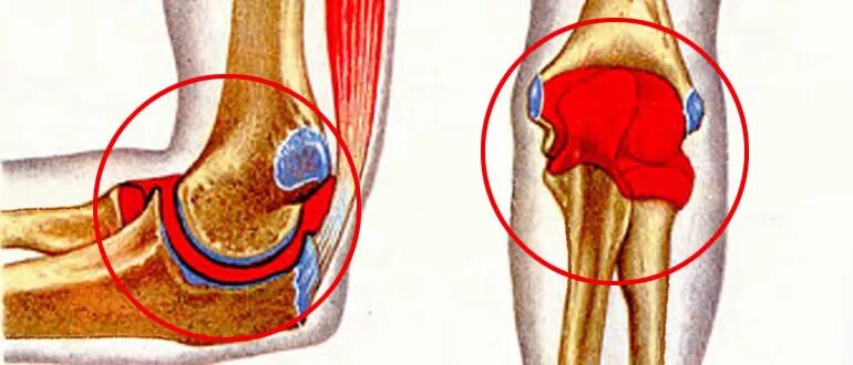 геперторз локстевоно сустава. кровоизлияние в полость сустава (гемартроз). гемартроз локтевого сустава. коленка диджитал. гемартроз локтевого сустава.