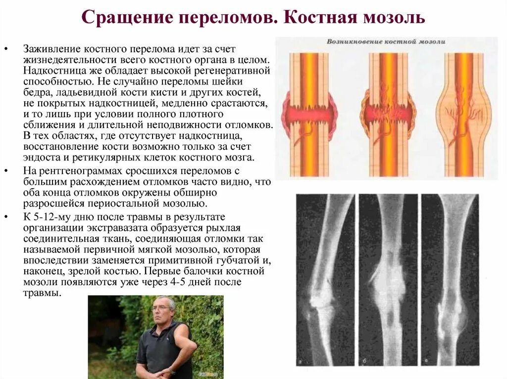 Стадии срастания перелома кости. Периостальная костная мозоль. Переломы (для ускорения консолидации костных отломков);. Костная мозоль после перелома сроки формирования.