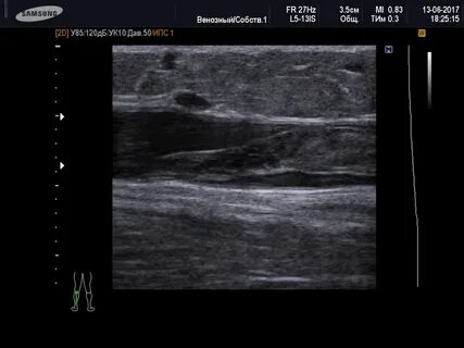 Флотирующий тромб нижней конечности