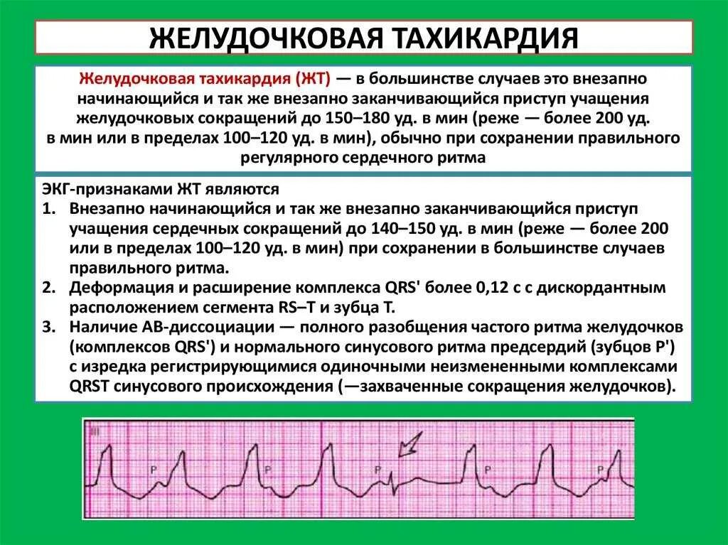 Лечение тахикардии при нормальном давлении. Синусовая тахикардия на экг. синусовая мерцательная аритмия экг. желудочковая тахикардия причины. давление при синусовой тахикардии.