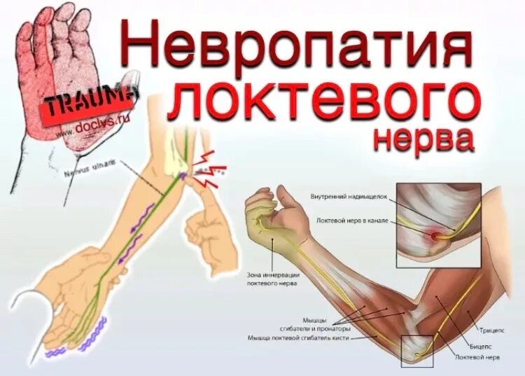 После операции немеют пальцы. Туннельные нейропатии локтевой нерв. Невропатия локтевого нерва симптомы. Туннельная нейропатия локтевого нерва симптомы. Нейропатия локтевого и лучевого нерва.