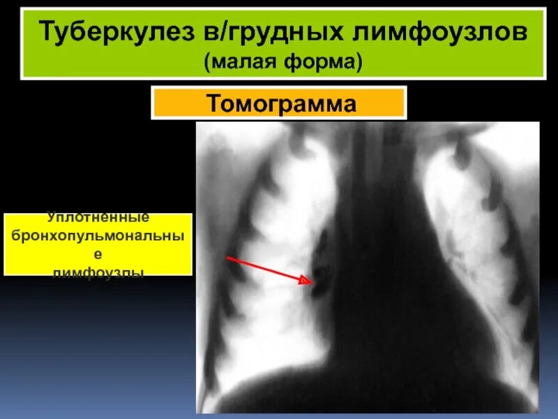 Туберкулез молочной. Малая форма туберкулеза внутригрудных лимфатических узлов. Туберкулез внутригрудных лимфоузлов малая форма. Туберкулез бронхопульмональных лимфоузлов\. Формы туберкулеза лимфатических узлов.