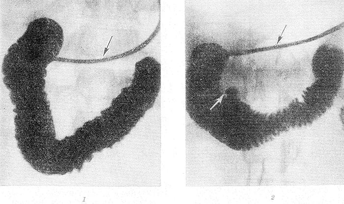 Гипотония желудка. Зондовая дуоденография. Рентген двенадцатиперстной кишки. Дуоденография 12 перстной кишки. Гипотоническая дуоденография.