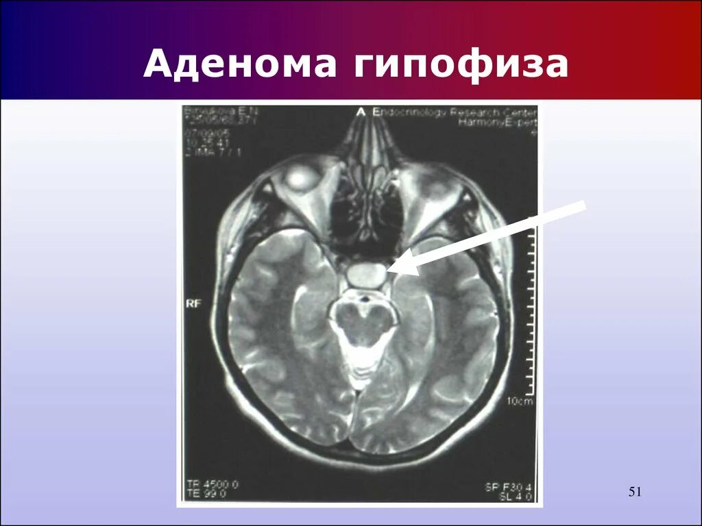 Гипофиз лечение. Гормонопродуцирующая аденома гипофиза. Эндоселлярная аденома гипофиза. Эозинофильная аденома гипофиза. Аденома гипофиза патология.