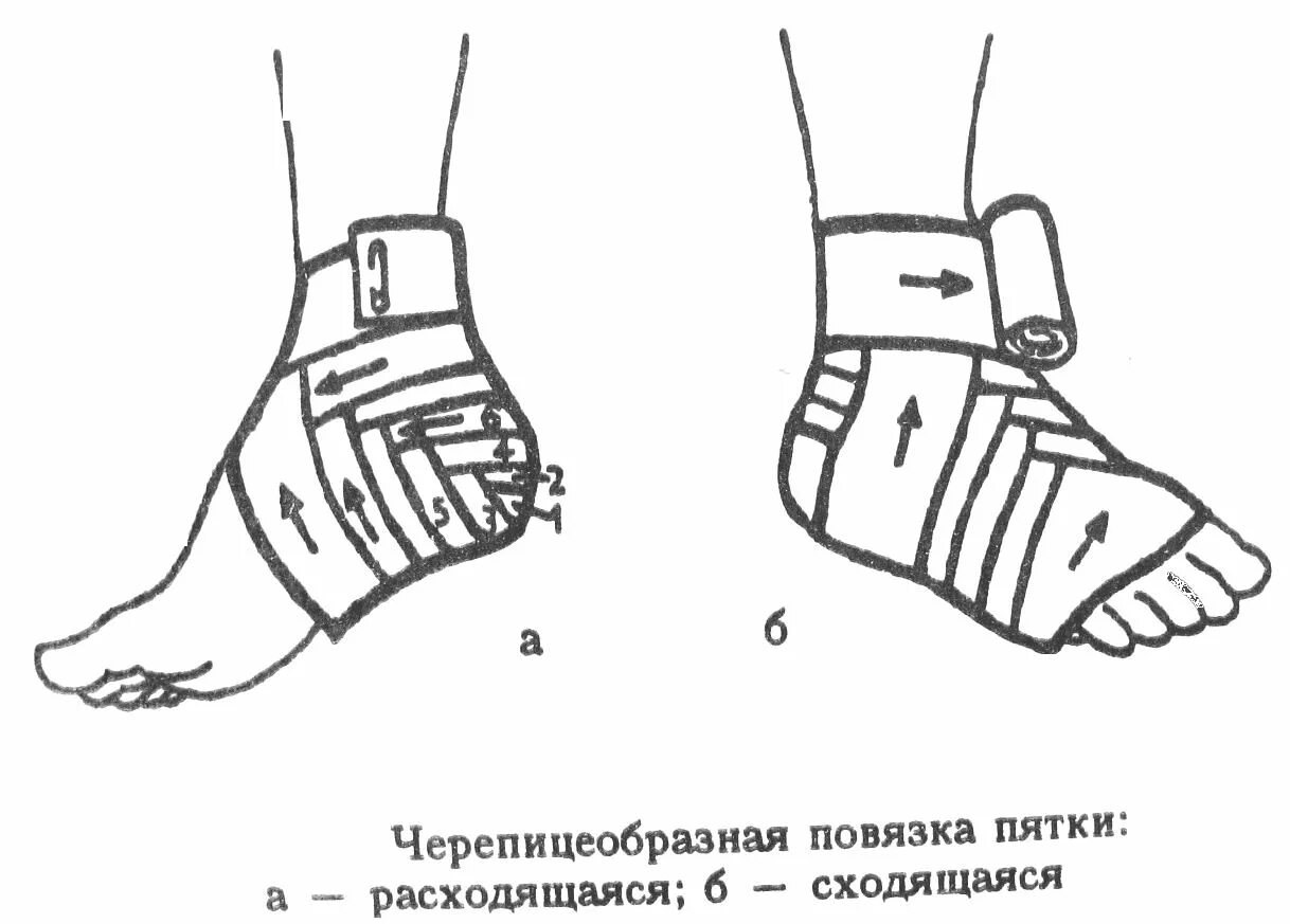 Повреждение голеностопного сустава какая повязка. Черепашья повязка на пятку алгоритм. черепашья повязка на пяточную поверхность. черепашья повязка на голеностоп. повязка на голеностоп сустава алгоритм.