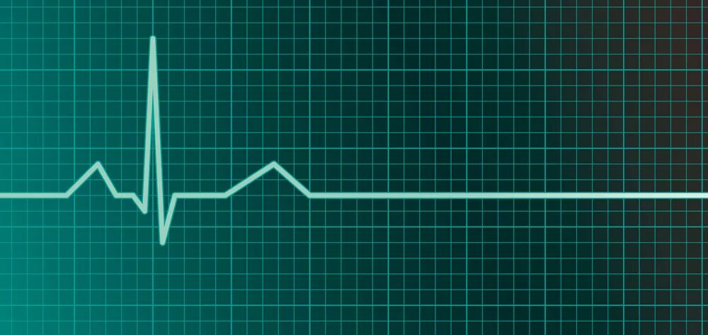 Пульс остановился. Прямая линия на кардиограмме. Кардиограмма остановки сердца. Прямая линия пульса. Прямая линия на ЭКГ.