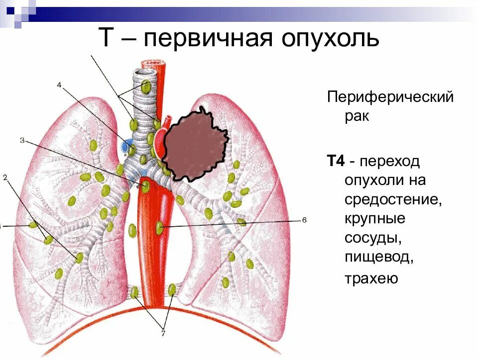 Метастазы в средостении легких