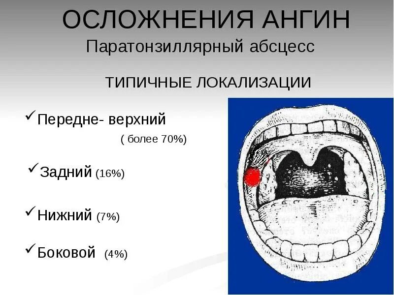 Клинические формы повышенного стирания. Тонзиллогенные осложнения. Осложнения частых ангин. Осложнения при тонзиллите. Местные осложнения ангины.